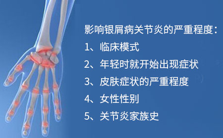 患有银屑病关节炎会残疾吗