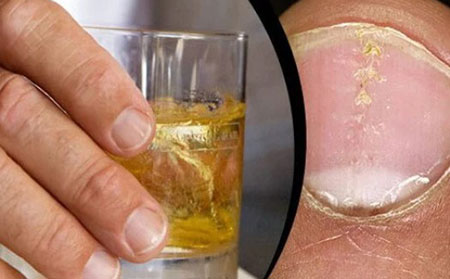 一些研究表明，大量饮酒与银屑病发作之间存在联系。