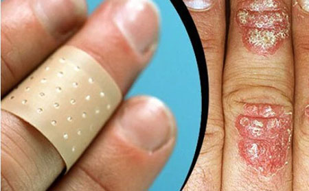 患有银屑病的人可能会在皮肤损伤部位出现银屑病病变。