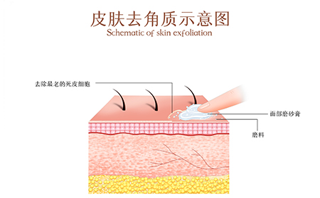 牛皮肤癣鳞状皮肤去角质