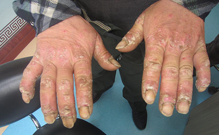 银屑病的症状还会让患者产生畸形的指甲