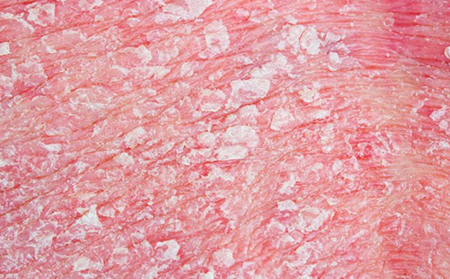 红皮病型银屑病是比较罕见的银屑病类型