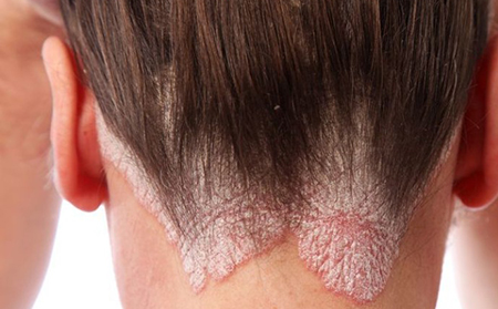 大约50%的银屑病患者在头皮上感染。