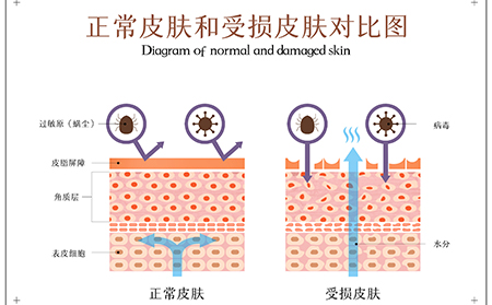 银屑病皮肤色素沉着