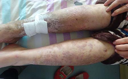 脚部银屑病症状,长丘疹是不是银屑病,潍坊东方银屑病研究院