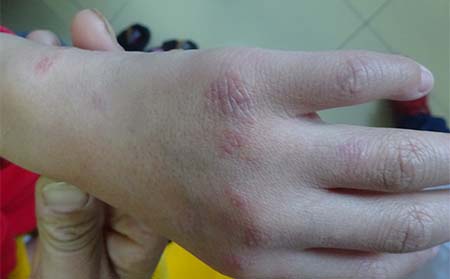 关节型银屑病症状,银屑病关节炎症状表现,潍坊东方银屑病研究院