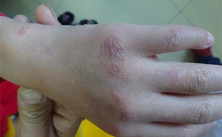手部银屑病症状,手上银屑病症状表现,潍坊东方银屑病研究院